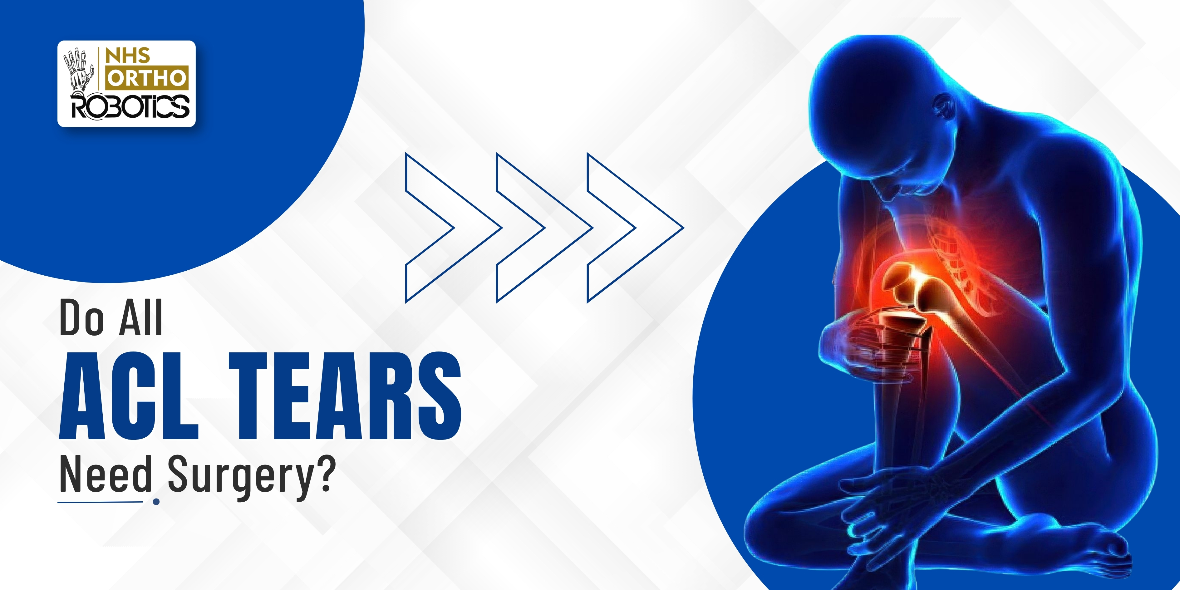 Do All ACL Tears Need Surgery?